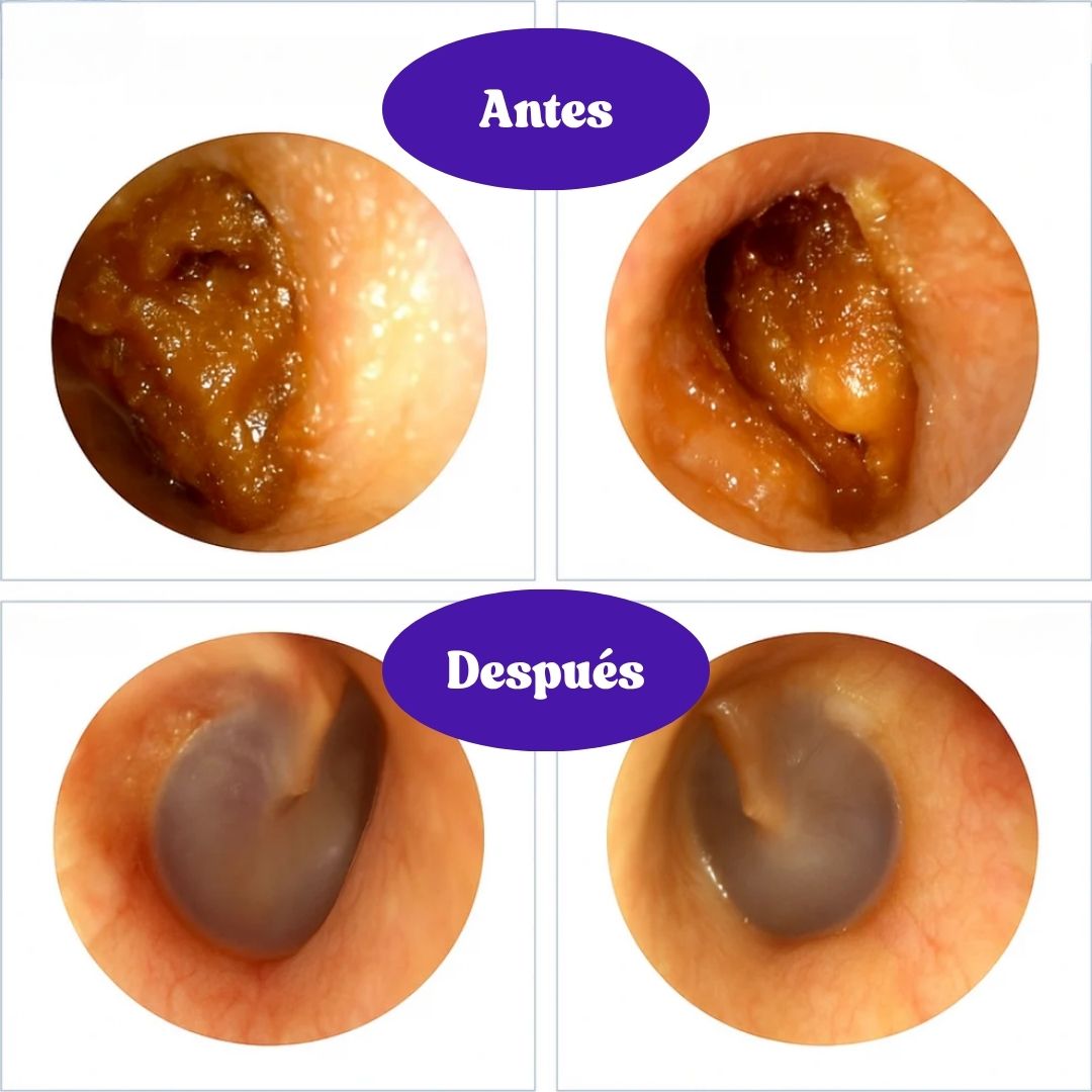 WaxKlean | Limpiador De Oídos Con Cámara remueve cera y mugre