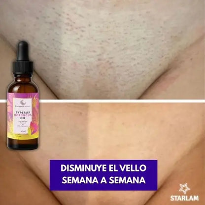 Serum Aceite de Cyperus inhibidor del crecimiento del vello